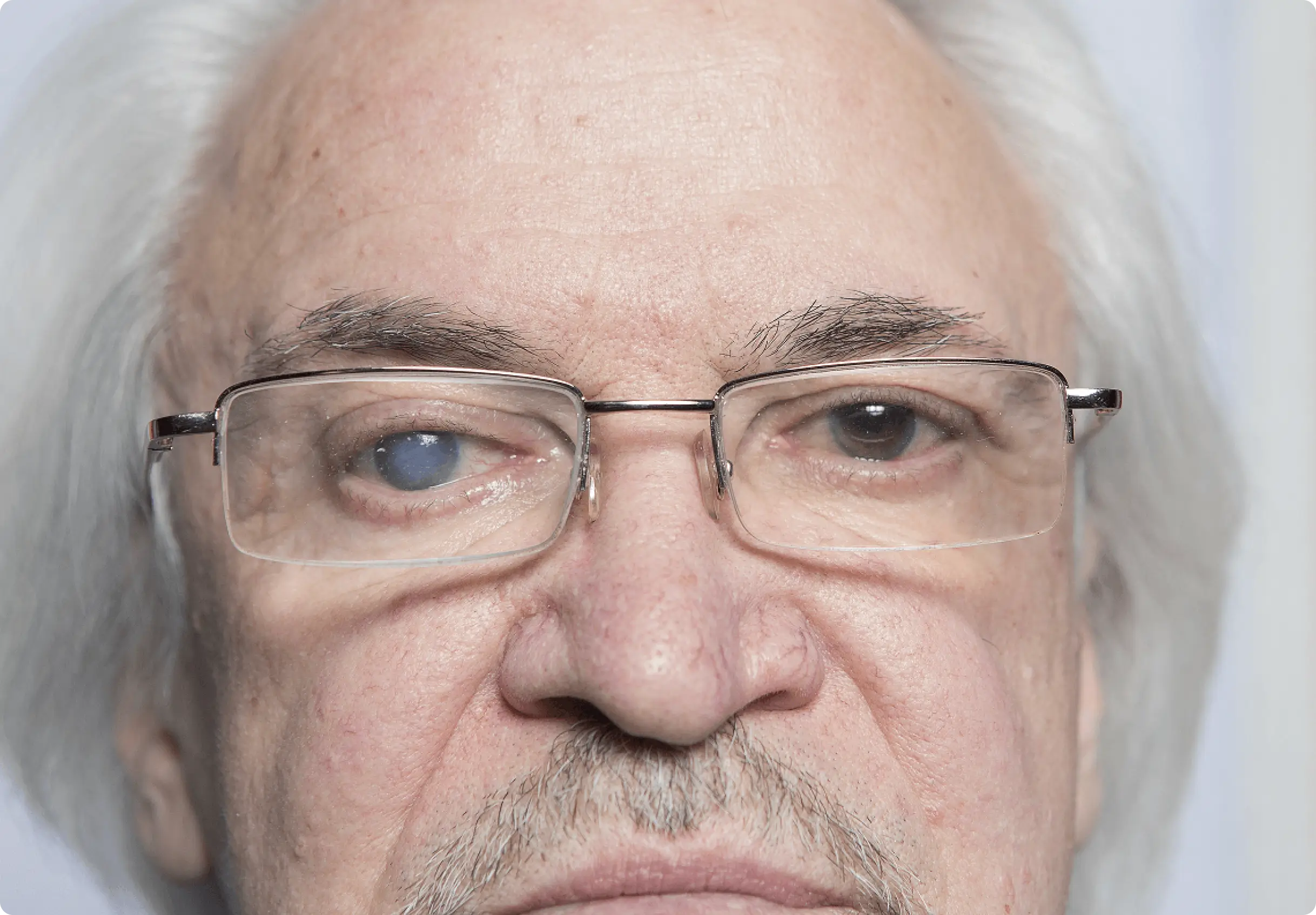 what are cataracts eye